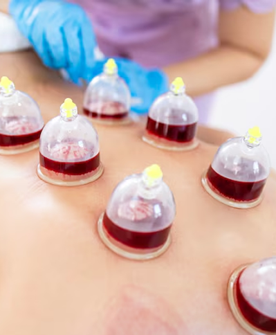 Cupping therapy for muscle recovery