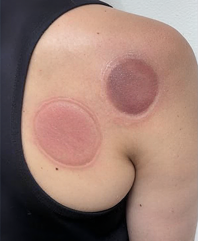 Cupping therapy marks on the back